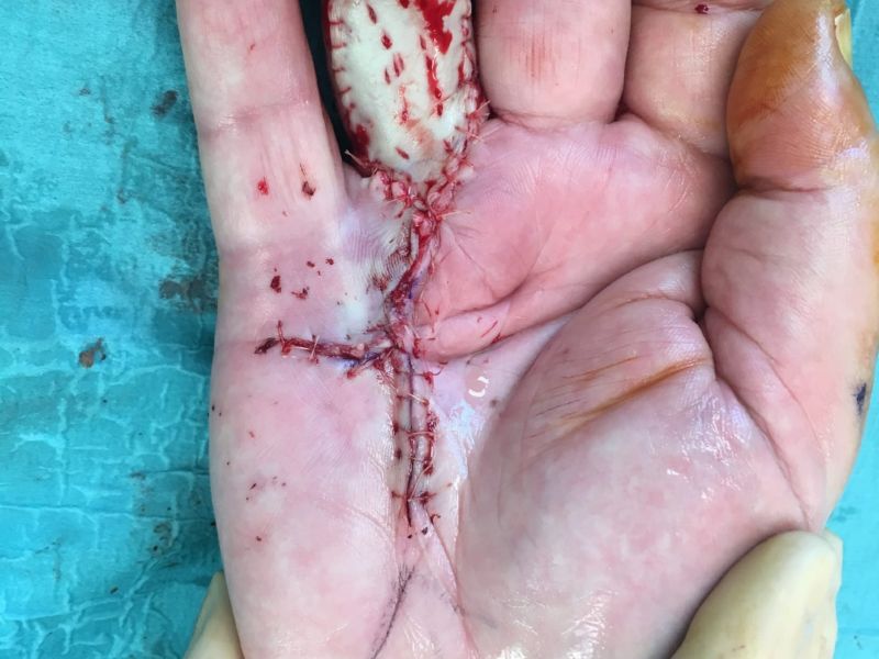 Hand affected by Dupuytren's disease during the Dermofasciectomy, with the skin graft sutured in place